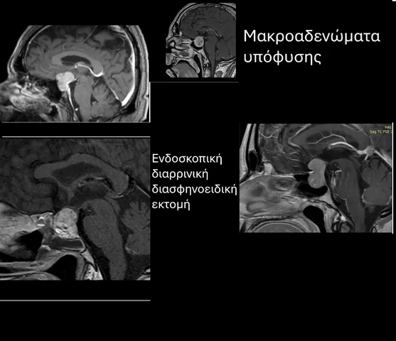 ΑΔΕΝΩΜΑΤΑ ΥΠΟΦΥΣΕΩΣ ΚΑΙ ΟΓΚΟΙ ΕΝ ΓΕΝΕΙ ΕΦΙΠΠΙΟΥ